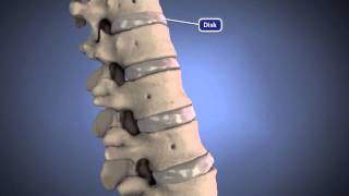 Herniated Disk [upl. by Fotina]