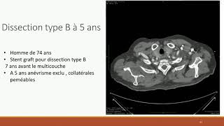 Prévention des anévrismes thoracoabdominaux après dissection aortique par stent multi couche [upl. by Nus536]