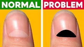 13 Health Problems Your Nails Warn You About amp Why Changes Your Lunula Color [upl. by Eatnoj915]