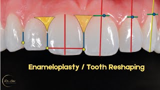 Enameloplasty  Tooth Reshaping of Anterior Tooth during Braces  Orthodontic Finishing [upl. by Ulund]