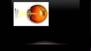 Cataracts Glaucoma and Macular Degeneration Video 6 [upl. by Gruber]