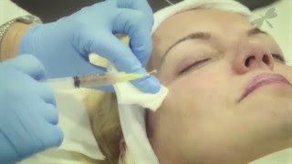 PRP Vampire Facelift The Laser and Skin Clinic [upl. by Llertniuq]