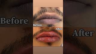 Permanent Lip Colour  Permanent Makeup  Akaya wellness  Jaipur [upl. by Orhtej]