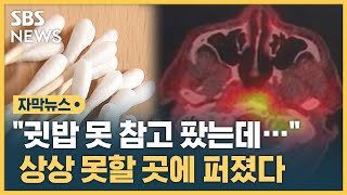 quot귓밥 못 참고 팠는데…quot 상상 못할 곳에 퍼졌다 자막뉴스  SBS [upl. by Genesa390]