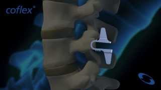 coflex® NonFusion Implant in Flexion and Extension  Paradigm Spine [upl. by Rusty]