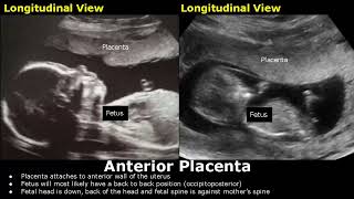 Placenta Positions On Ultrasound  AnteriorPosteriorFundalLateral Placental Positioning USG [upl. by Chemush41]