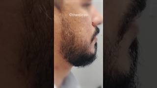 ANTES E DEPOIS MINOXIDIL 2 anos e 3 meses de tratamento minoxidil barba thedicas [upl. by Llerrad]