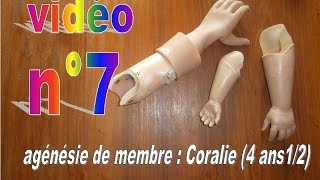 agénésie Coralie 4 ans 12  vidéo n°7 [upl. by Karrie]