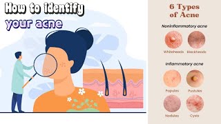 how to get rid of acne  clearing acne ultimate treatment guide acne treatment [upl. by Pilar30]