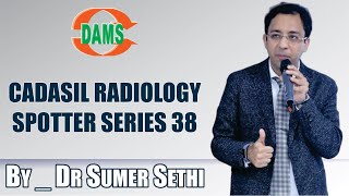 CADASIL Radiology Spotter Series 38 By Dr Sumer Sethi [upl. by Kosel922]