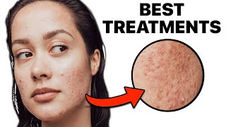 How To Get Rid of Acne Scars [upl. by Buine249]