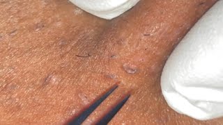 Ingrown Hair Removal Ep29 [upl. by Seidel]