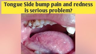 Tongue Side Bump Pain burningitchingWhat to do when back side of tongue bump causes irritation [upl. by Kcirb]