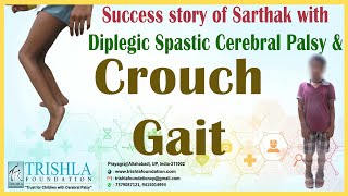 Success story of Sarthak with Diplegic Spastic Cerebral Palsy amp crouch gait  Trishla Foundation [upl. by Cailly]