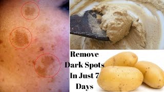 Remove Dark Spots amp Acne Scars In Just 7 Days 100 Effective Home Remedy Potato For Spotless Skin [upl. by Ng]