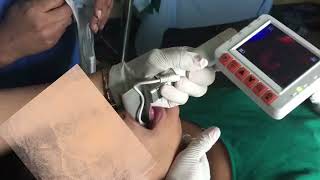 Intubation procedure [upl. by Nylecaj819]