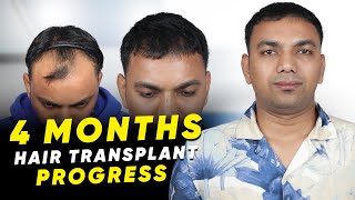 Hair Transplant in Satara  Best Results amp Cost of Hair Transplant in Satara [upl. by Streeter]