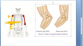 Orthopedics 121 SupraCondylar Fracture humerus cubitus varus gun stock deformity Volkmann ischemia [upl. by Enelez298]