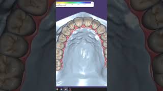 Exocad implant design [upl. by Sherl]