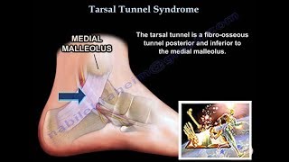 Tarsal Tunnel Syndrome  Everything You Need To Know  Dr Nabil Ebraheim [upl. by Nylrehs]