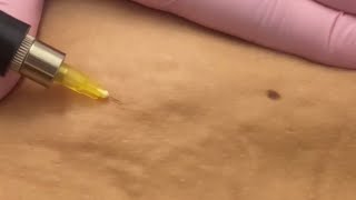 Carboxiterapia corporal La mejor herramienta para eliminar la fibrosis post operatoria 💙 [upl. by Tatianas]