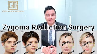 ZygomaCheekbone Reduction Explained  Seoul Guide Medical cheekbonereduction zygomareduction [upl. by Norved]