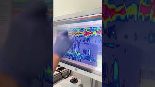 Esophageal Manometry Test with Austin Gastro November 2024 [upl. by Thain]