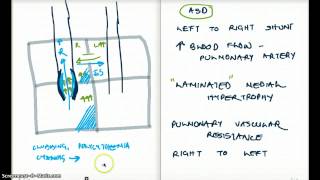 ASD Eisenmengers Syndrome Fixed Split and Surgery [upl. by Engapmahc]