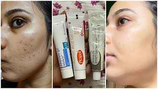 Dermatologist Recommended Best 3 Creams to remove Pimple Marks Acne Scars Dark Spots PIH [upl. by Pitt223]