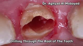 DrAghyad  Buccalsocket  shield Technique with dental implant placement [upl. by Ateekahs]