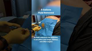 5 Gallons Drained From Abdomen  40lbs of Fluid shorts [upl. by Elirpa]