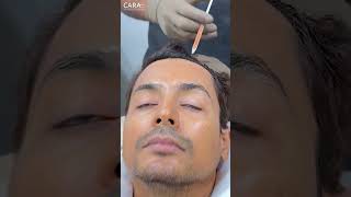 Trichometric PRP Hair Treatment to Deal With Hair Loss [upl. by Amesari]