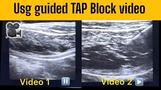 TAP BLOCK Ultrasound Video How to correctly find the correct plane  nervepainrelief [upl. by Cleasta]