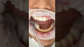 Veneers Placement Timelapse Watch This StepbyStep Guide for a Perfect Smile shorts Timelapse [upl. by Aisatana741]