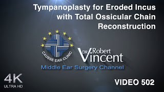 Tympanoplasty for Eroded Incus with Total Ossicular Chain Reconstruction [upl. by Neumann]