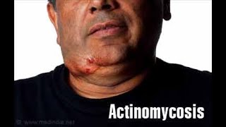 Actinomycosis Symptoms and Causes  Diagnosis  Treatment  Prevention [upl. by Usanis]