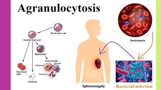 agranulocytosis [upl. by Sremlahc509]