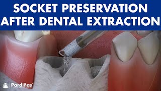 Tooth extraction  Treatment for socket preservation © [upl. by Ruberta485]