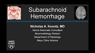 Subarachnoid Hemorrhage [upl. by Assirak]