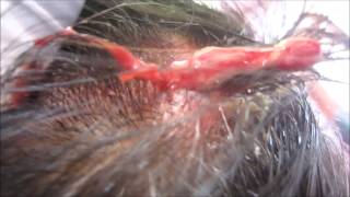 Scalp Abscess [upl. by Demaria359]