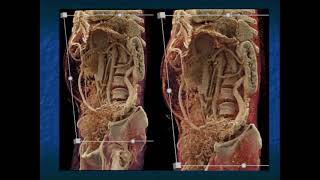 Gastric GIST Tumors Pearls and Pitfalls  Part 3 [upl. by Olnee]