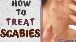 HOW TO TREAT SCABIESscabies treatment at home [upl. by Ecineg]