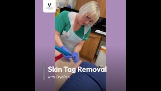 Skin Tag Removal with CryoPen at DRVICTORIA™ Clinic in Edinburgh [upl. by Acimot]