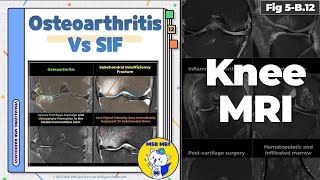 Fig 5B12 Osteoarthritis vs Subchondral Insufficiency Fracture [upl. by Jenna382]