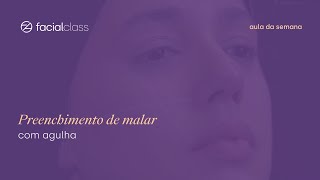 Preenchimento de malar com agulha  Facial Class [upl. by Ainevuol]