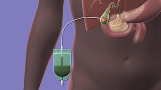 Your Percutaneous Cholecystostomy Drain [upl. by Ayeki]