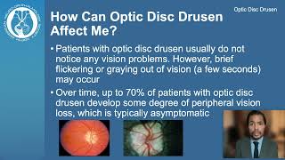 Optic Disc Drusen [upl. by Ciredor728]