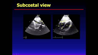 Basics in Echocardiography [upl. by Chamberlain]