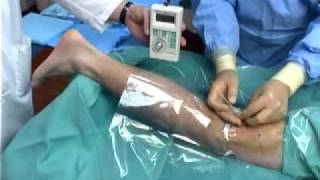 Continuous Popliteal Nerve Block [upl. by Eidassac]