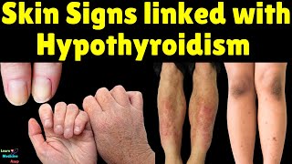 Skin Signs linked with Hypothyroidism Underactive Thyroid [upl. by Haleigh93]